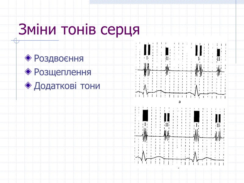 Зміни тонів серця Роздвоєння Розщеплення Додаткові тони